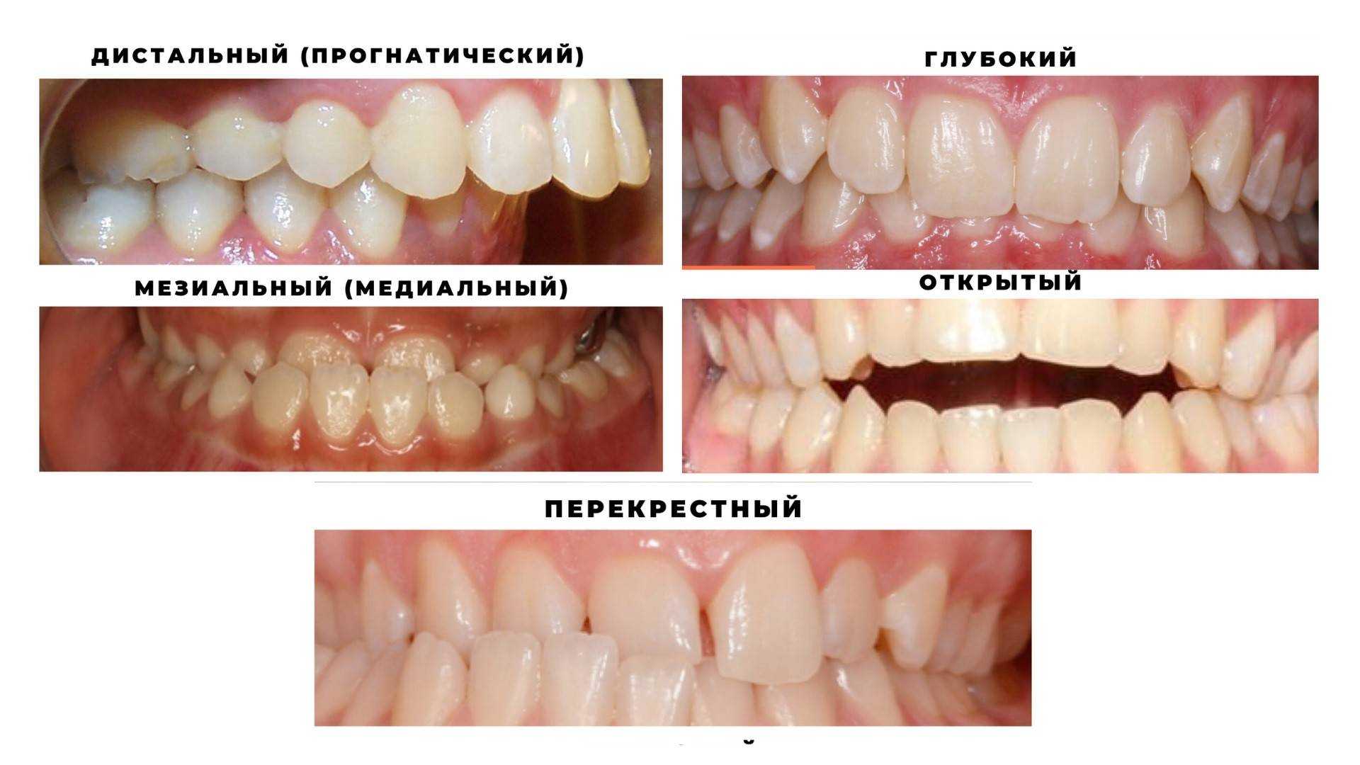 Классификация зубочелюстных аномалий энгля