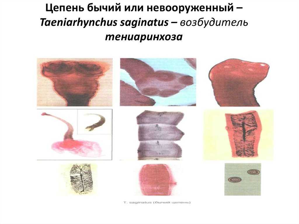 Тениаринхоз - бычий цепень | университетская клиника